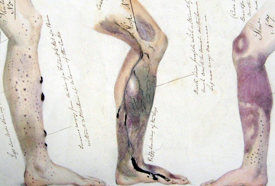Illustration of Scurvy damage to the leg on Convicts by Surgeon Henry Walsh Mahon, 1841